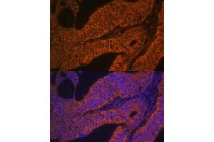 Immunofluorescence analysis of human colon carcinoma using RB antibody (ABIN6128601, ABIN6146597, ABIN6146598 and ABIN6223325) at dilution of 1:100. (RAB5B Antikörper  (AA 1-215))