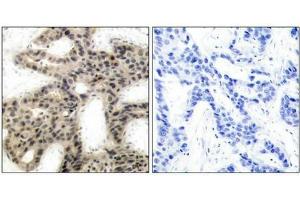 Immunohistochemical analysis of paraffin-embedded human breast carcinoma tissue using 4E-BP1(Phospho-Thr45) Antibody(left) or the same antibody preincubated with blocking peptide(right). (eIF4EBP1 Antikörper  (pThr45))