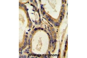CCL4 Antibody (Center) immunohistochemistry analysis in formalin fixed and paraffin embedded human prostate carcinoma followed by peroxidase conjugation of the secondary antibody and DAB staining. (CCL4 Antikörper  (Middle Region))