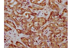 IHC image of ABIN7165570 diluted at 1:400 and staining in paraffin-embedded human liver cancer performed on a Leica BondTM system. (FAM83G Antikörper  (AA 464-615))