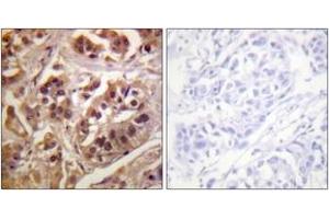 Immunohistochemistry analysis of paraffin-embedded human lung carcinoma tissue, using IKK-gamma (Ab-31) Antibody. (IKBKG Antikörper  (AA 16-65))