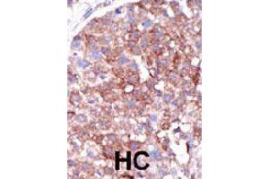 Formalin-fixed and paraffin-embedded human hepatocellular carcinoma tissue reacted with SMURF1 polyclonal antibody  , which was peroxidase-conjugated to the secondary antibody, followed by DAB staining. (SMURF1 Antikörper  (C-Term))