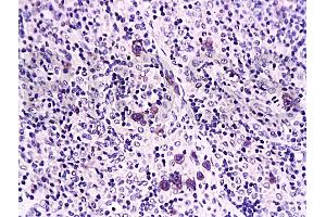 Formalin-fixed and paraffin embedded rat transplant lymphoma labeled with Anti-Caspase-1 Polyclonal Antibody, Unconjugated (ABIN725780) at 1:200 followed by conjugation to the secondary antibody and DAB staining (Caspase 1 (p10) Antikörper  (AA 320-404))