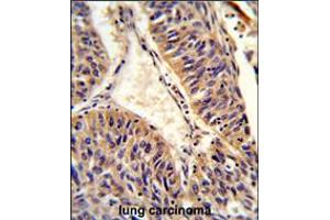 Formalin-fixed and paraffin-embedded human lung carcinoma reacted with ALG14 Antibody , which was peroxidase-conjugated to the secondary antibody, followed by DAB staining. (ALG14 Antikörper  (AA 67-93))