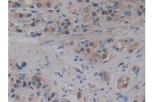 DAB staining on IHC-P; Samples: Human Prostate cancer Tissue (ALOX15B Antikörper  (AA 253-490))
