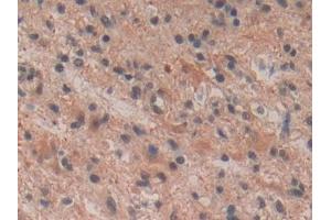 DAB staining on IHC-P; Samples: Human Glioma Tissue (Tachykinin 3 Antikörper  (AA 23-121))