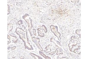 Immunohistochemistry analysis of paraffin-embedded human colon cancer using MMP2 Polyclonal Antibody at dilution of 1:500. (MMP2 Antikörper)