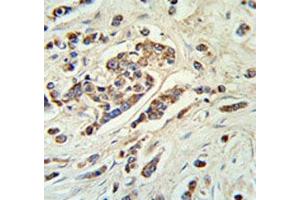 ABCC11 antibody IHC analysis in formalin fixed and paraffin embedded breast carcinoma. (ABCC11 Antikörper  (AA 343-372))
