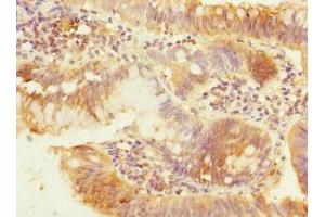 Immunohistochemistry of paraffin-embedded human colon cancer using ABIN7162961 at dilution of 1:100 (PEX19 Antikörper  (AA 1-299))
