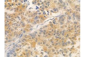 ABIN7095030 and ABIN7099086 at 1/100 staining human lung squamous cell carcinoma by IHC-P. (TMEM199 Antikörper)