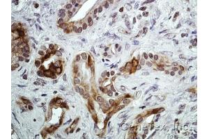 IHC-P Image Immunohistochemical analysis of paraffin-embedded Human pancreatic tumor, using CXCR7, antibody at 1:100 dilution. (CXCR7 Antikörper)