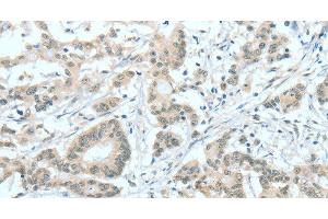 Immunohistochemistry of paraffin-embedded Human colon cancer tissue using ASH2L Polyclonal Antibody at dilution 1:60 (ASH2L Antikörper)