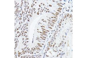 Immunohistochemistry of paraffin-embedded human colon carcinoma using YE Rabbit pAb (ABIN6130808, ABIN6150331, ABIN6150332 and ABIN6221925) at dilution of 1:100 (40x lens). (GAS41 Antikörper  (AA 1-227))