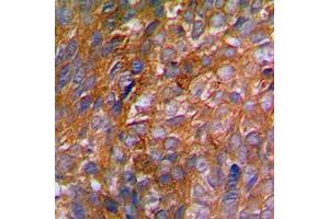 Immunohistochemical analysis of c-CBL (pY774) staining in human breast cancer formalin fixed paraffin embedded tissue section. (CBL Antikörper  (C-Term, pTyr774))
