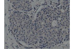 Immunohistochemical staining of paraffin-embedded Adenocarcinoma of Human breast tissue using anti-SH3GL1 mouse monoclonal antibody.