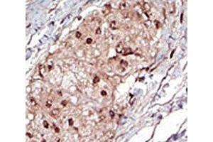 IHC analysis of FFPE human hepatocarcinoma tissue stained with the SPHK1 antibody (SPHK1 Antikörper  (AA 286-315))