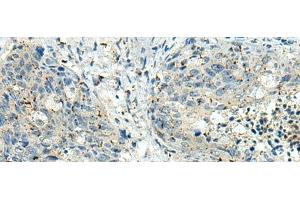 Immunohistochemistry of paraffin-embedded Human cervical cancer tissue using PAK1IP1 Polyclonal Antibody at dilution of 1:120(x200) (PAK1IP1 Antikörper)