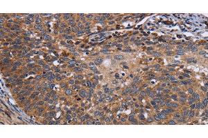 Immunohistochemistry of paraffin-embedded Human cervical cancer tissue using LRRC15 Polyclonal Antibody at dilution 1:60 (LRRC15 Antikörper)