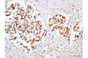 Formalin-fixed and paraffin embedded human colon carcinoma labeled with Rabbit Anti-Ep300 (Ser1834) Polyclonal Antibody, Unconjugated (ABIN800613) at 1:200 followed by conjugation to the secondary antibody and DAB staining (p300 Antikörper  (pSer1834))