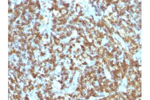 Formalin-fixed, paraffin-embedded human Lymphoma stained with CD45RO Monoclonal Antibody (SPM125). (CD45 Antikörper)