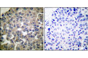 Immunohistochemical analysis of paraffin-embedded human breast carcinoma tissue using PLCG1 (Ab-771) antibody. (Phospholipase C gamma 1 Antikörper)