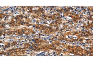 Immunohistochemistry of paraffin-embedded Human gasrtic cancer tissue using CD13 Polyclonal Antibody at dilution 1:80 (CD13 Antikörper)