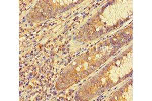 Immunohistochemistry of paraffin-embedded human colon cancer using ABIN7153793 at dilution of 1:100