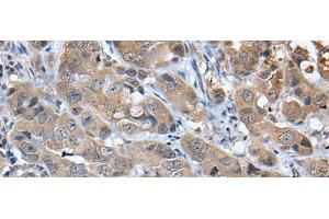 Immunohistochemistry of paraffin-embedded Human breast cancer tissue using CXCL5 Polyclonal Antibody at dilution of 1:45(x200) (CXCL5 Antikörper)