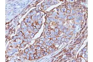 Formalin-fixed, paraffin-embedded human breast carcinoma stained with CD44 antibody (DF1485)