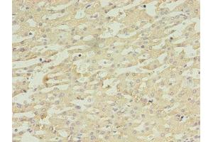 Immunohistochemistry of paraffin-embedded human liver cancer using ABIN7149554 at dilution of 1:100 (DAPK2 Antikörper  (AA 222-370))