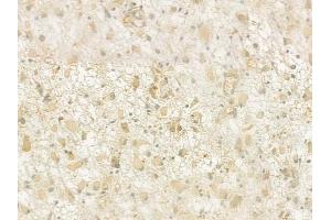 ABIN6261305 and ABIN6276929 at 1/100 staining human glioblastoma by IHC-P.
