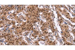 Immunohistochemistry of paraffin-embedded Human gasrtic cancer tissue using ID4 Polyclonal Antibody at dilution 1:40 (ID4 Antikörper)