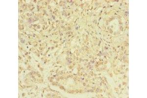 Immunohistochemistry of paraffin-embedded human pancreatic cancer using ABIN7169347 at dilution of 1:100 (SERPINB6 Antikörper  (AA 180-300))