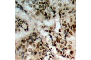 Immunohistochemical analysis of PTEN (pS380/T382/T383) staining in human prostate cancer formalin fixed paraffin embedded tissue section. (PTEN Antikörper  (C-Term, pSer380, pThr382, pThr383))