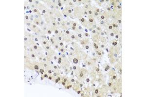 Immunohistochemistry of paraffin-embedded human liver injury using FUBP1 antibody. (FUBP1 Antikörper)