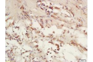 Formalin-fixed and paraffin embedded human laryngeal carcinoma labeled with Rabbit Anti-COX6c/Cytochrome C Oxidase subunit VIc Polyclonal Antibody, Unconjugated (ABIN1714715) at 1:200 followed by conjugation to the secondary antibody and DAB staining (COX6C Antikörper  (AA 21-75))