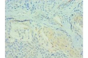Immunohistochemistry of paraffin-embedded human breast cancer using ABIN7164694 at dilution of 1:100 (PDCD4 Antikörper  (AA 1-260))
