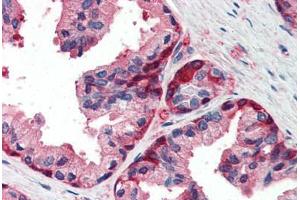 Human Prostate (formalin-fixed, paraffin-embedded) stained with GSTP1 antibody ABIN337104 at 5 ug/ml followed by biotinylated anti-goat IgG secondary antibody ABIN481715, alkaline phosphatase-streptavidin and chromogen. (GSTP1 Antikörper  (AA 22-33))