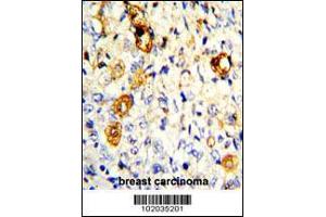 Formalin-fixed and paraffin-embedded human breast carcinoma with MMP19 Antibody , which was peroxidase-conjugated to the secondary antibody, followed by DAB staining. (MMP19 Antikörper  (C-Term))