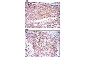 Immunohistochemical staining of human prostate cancer tissues (A) and bladder cancer tissues (B) with CAMK2G monoclonal antibody, clone 8G10C1  at 1:200-1:1000 dilution.