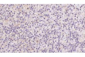 ABIN6273093 at 1/100 staining Human lymph cancer tissue by IHC-P. (BBS7 Antikörper  (Internal Region))
