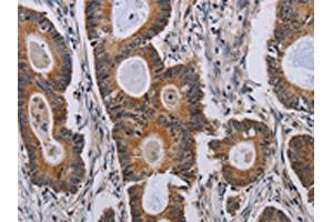 The image on the left is immunohistochemistry of paraffin-embedded Human colon cancer tissue using ABIN7191791(PARP8 Antibody) at dilution 1/40, on the right is treated with synthetic peptide. (PARP8 Antikörper)
