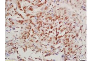 Formalin-fixed and paraffin embedded human lung carcinoma labeled with Rabbit Anti-BTK (Tyr223) Polyclonal Antibody, Unconjugated  at 1:200 followed by conjugation to the secondary antibody and DAB staining (BTK Antikörper  (pTyr223))