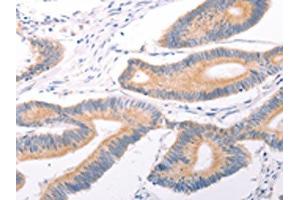 The image on the left is immunohistochemistry of paraffin-embedded Human colon cancer tissue using ABIN7131495(TRPC7 Antibody) at dilution 1/25, on the right is treated with fusion protein. (TRPC7 Antikörper)