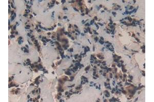 DAB staining on IHC-P; Samples: Human Breast cancer Tissue (TAF12 Antikörper  (AA 1-161))