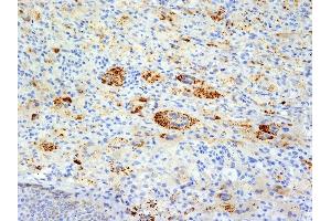 Formalin-fixed, paraffin-embedded human Erdheim-Chester disease (also known as polyostotic sclerosing histiocytosis) stained with TNF alpha Mouse Monoclonal Antibody (TNFA/1172). (TNF alpha Antikörper)