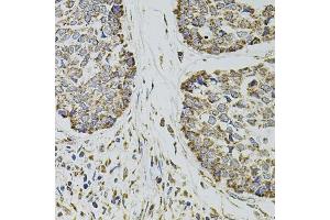 Immunohistochemistry of paraffin-embedded human esophageal cancer using CD62P/P-selectin antibody (ABIN6131514, ABIN6147503, ABIN6147506 and ABIN6218519) at dilution of 1:100 (40x lens). (P-Selectin Antikörper  (AA 30-200))