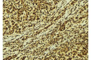 ABIN6269328 at 1/100 staining Human breast cancer tissue by IHC-P.