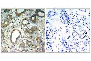 Immunohistochemical analysis of paraffin-embedded human breast carcinoma tissue, using SHP-2 (Phospho-Tyr580) antibody (E011320). (PTPN11 Antikörper  (pTyr580))