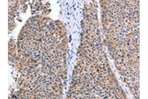 The image on the left is immunohistochemistry of paraffin-embedded Human liver cancer tissue using ABIN7131299(TAT Antibody) at dilution 1/35, on the right is treated with fusion protein. (Tat Antikörper)